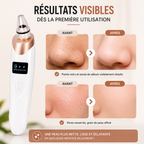 ClearSkin Pro™ - Aspirateur à points noirs